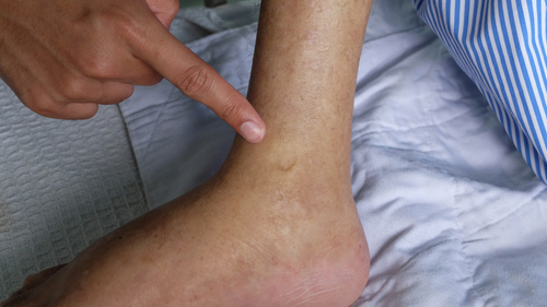 むくみや倦怠感など症状